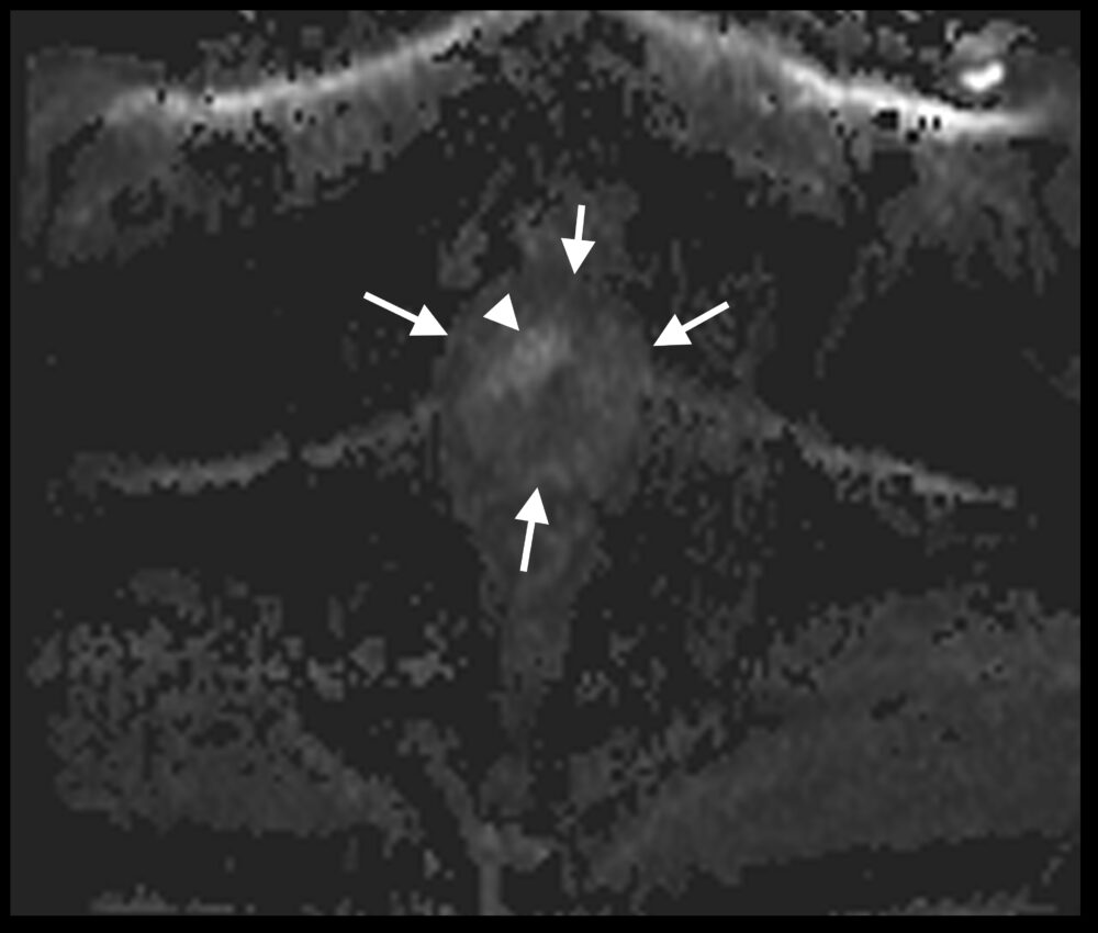 Imaging Prostate Cancer - myCME