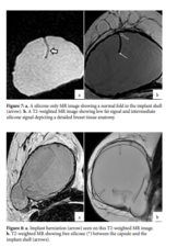 Imaging Breast Implant Rupture – Part II - myCME